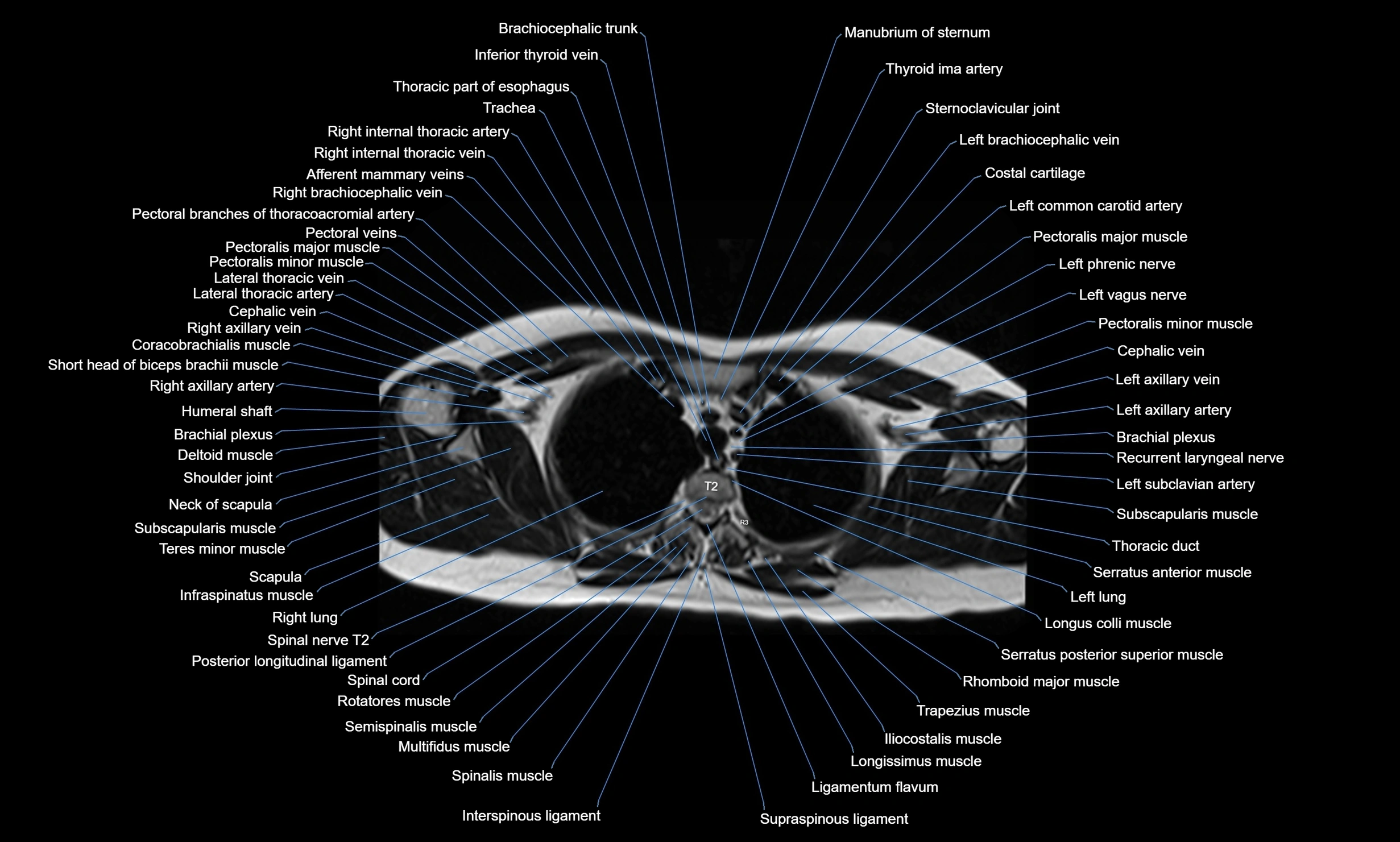 MRI chest axial  cross sectional anatomy 3T radiology  image-img-00001-00010.webp